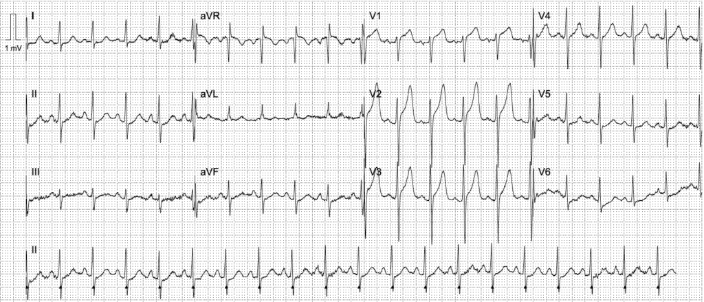 Activate or wait ECG 2606 1 LITFL