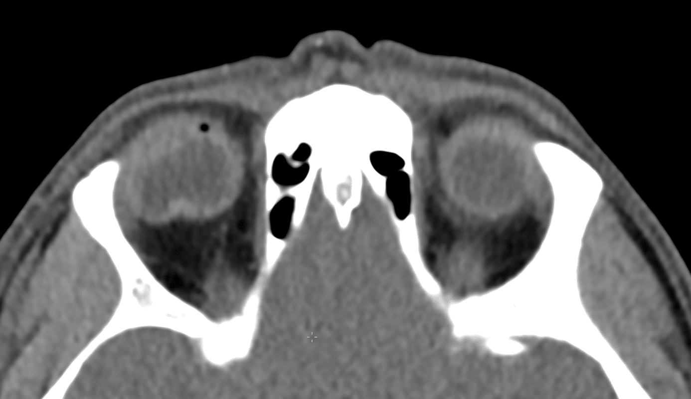 CT Case 020 LITFL CT Scan Interpretation