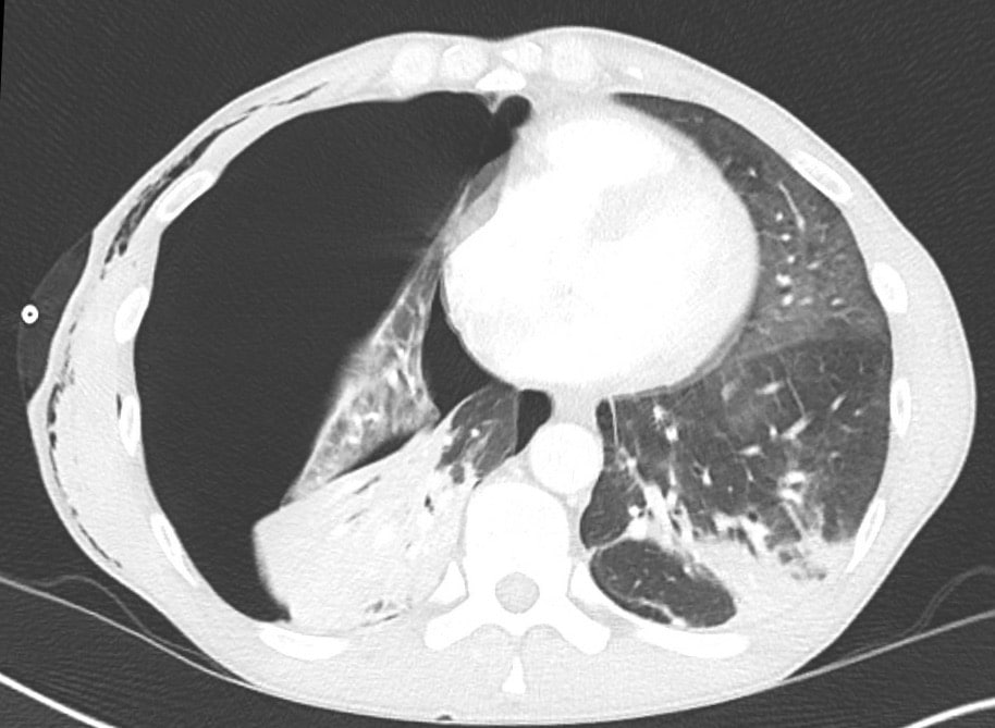 CT Case 029 • LITFL • CT scan interpretation