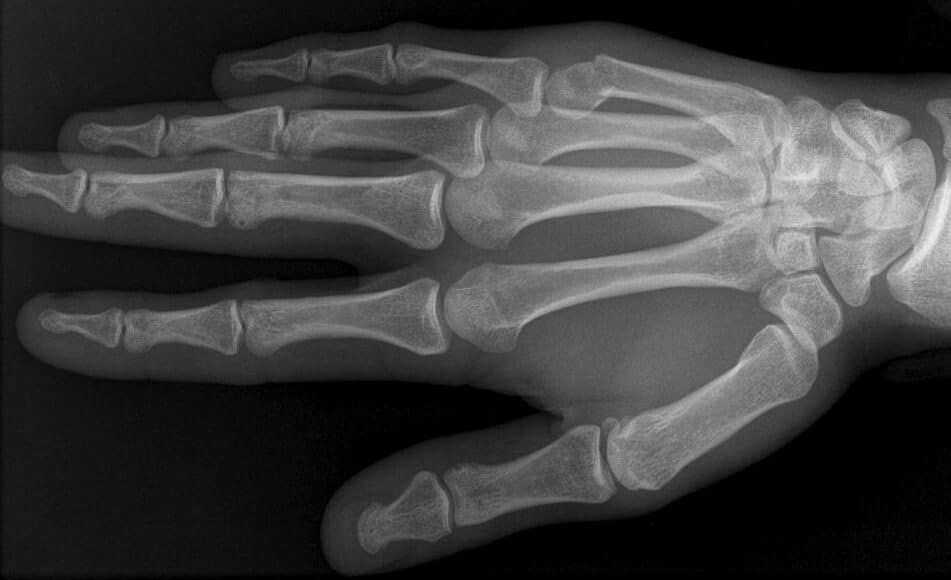 Ulnar Gutter Splint  Metacarpal and Boxer's Fracture Treatment