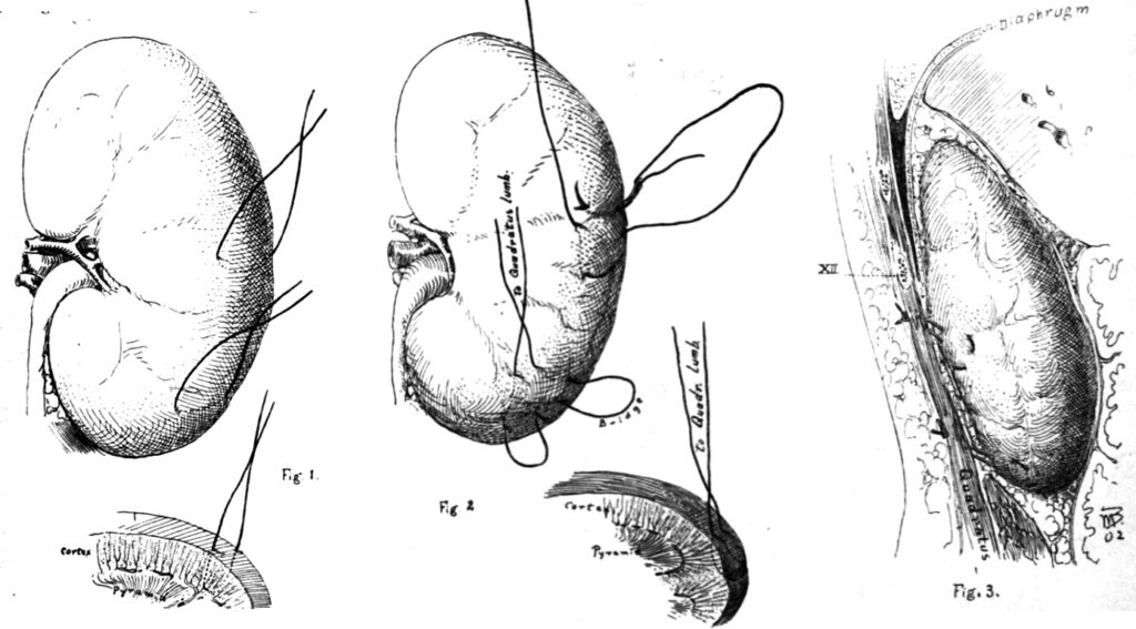 Brödel’s Suture 1902