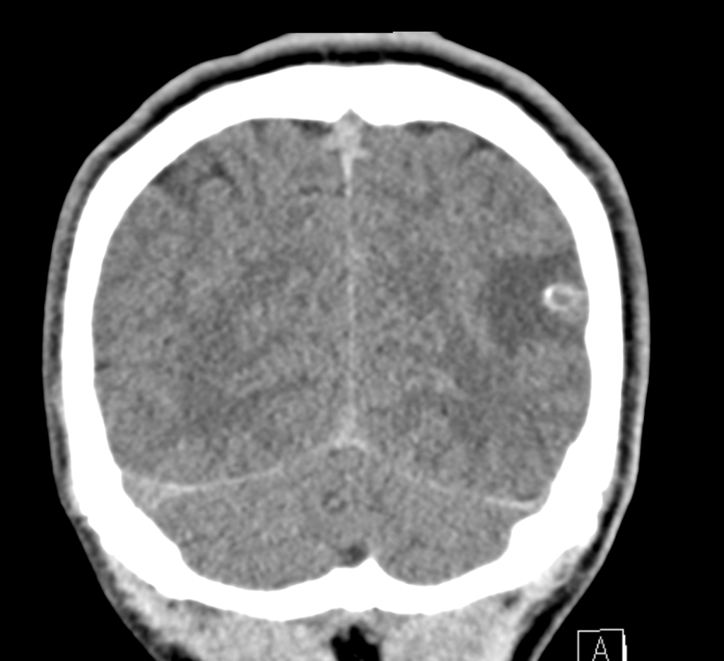 CT Case 033 01