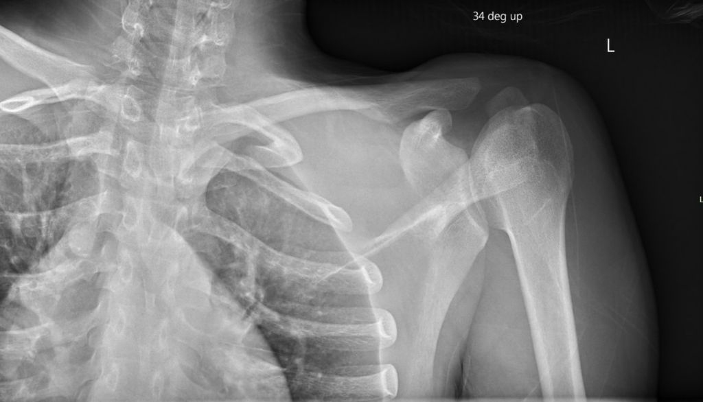 CT Case 035 XR SCJ dislocation