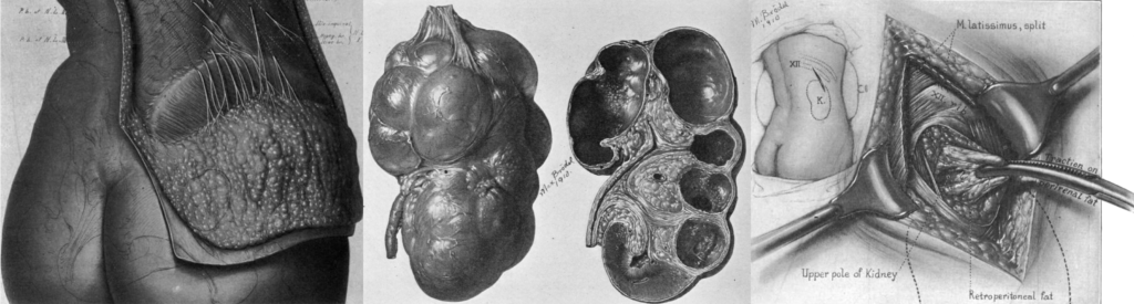 Diseases of the kidneys, ureters and bladder Kelly 1914