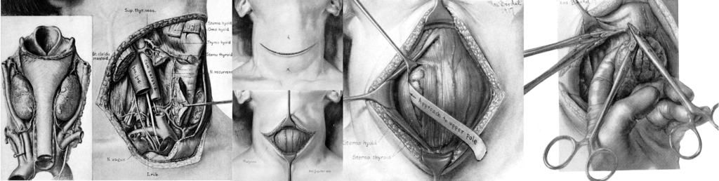 Halsted operation for operation for exophthalmic goitre
