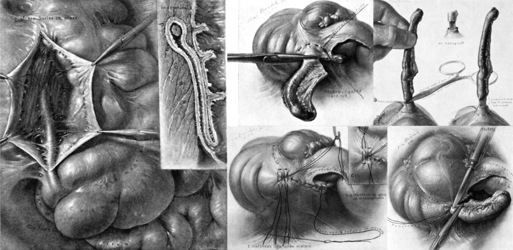 The vermiform appendix and its diseases Kelly 1905