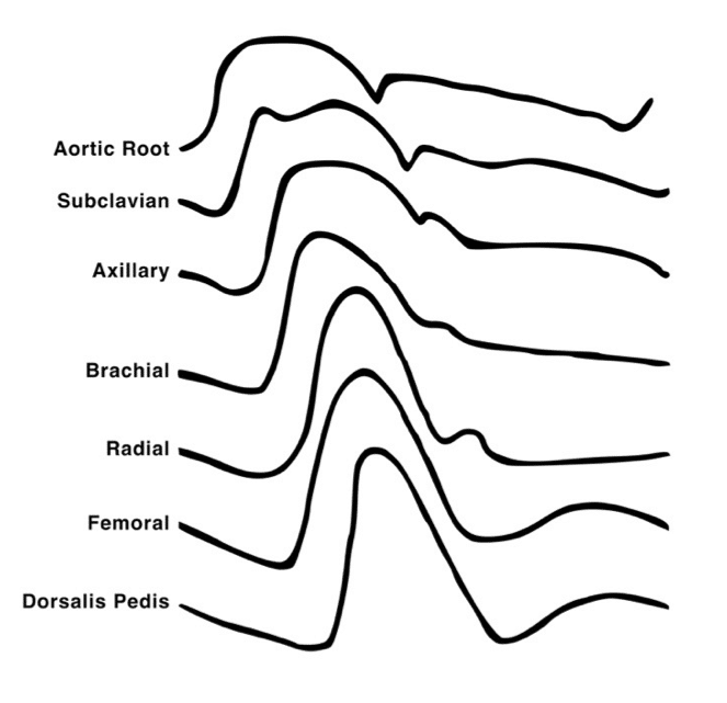 https://litfl.com/wp-content/uploads/2023/08/Changes-in-arterial-waveform-at-different-sites.png