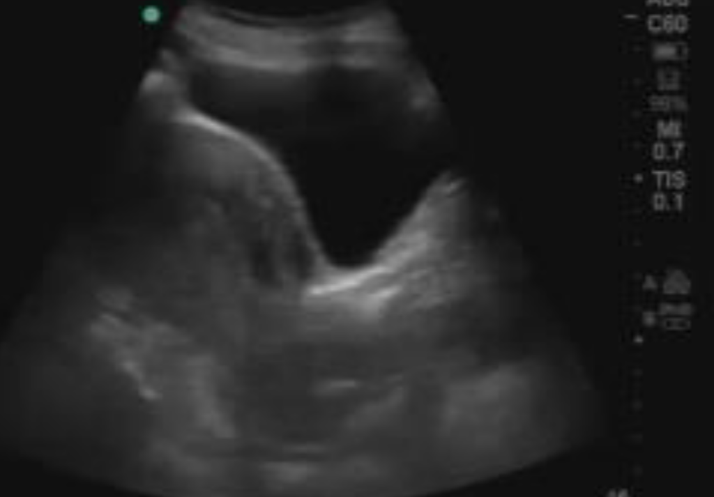 eFAST Pelvis