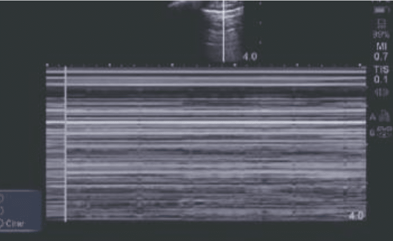 eFAST Pneumothorax Barcode sign