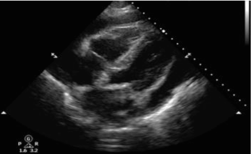 eFAST SUBX Pericardial effusion