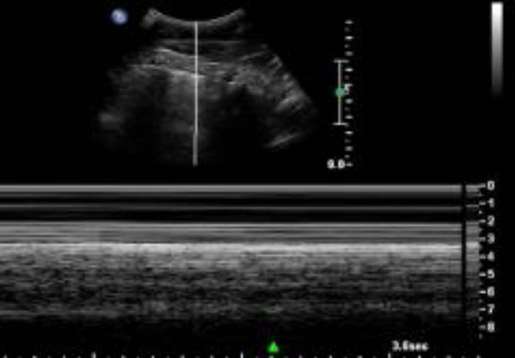 eFAST right Chest view