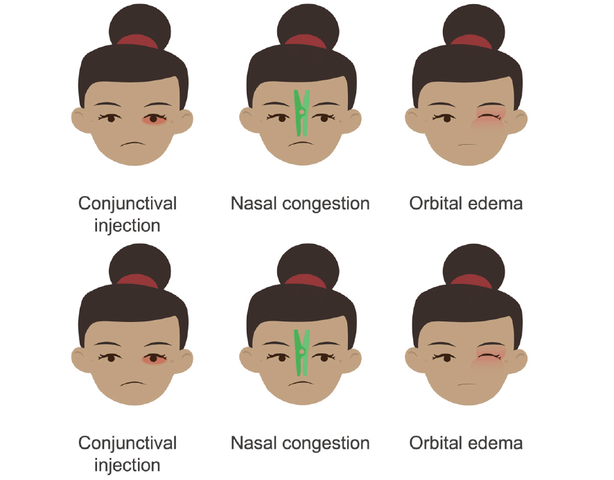 Trigeminal Autonomic Cephalalgias • Litfl • Neurology Library