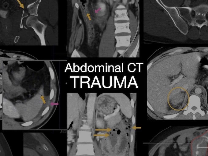 Abdominal CT Trauma 680