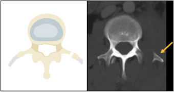 Abdominal CT: body wall injuries • LITFL • Radiology