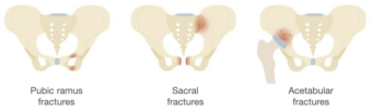 Abdominal CT Pelvic Fractures LITFL Radiology Abdominal CT Pelvic Fractures LITFL Radiology