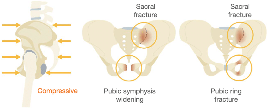 Abdominal CT Pelvic Fractures LITFL Radiology