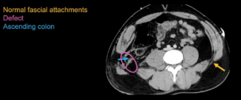 Abdominal CT: body wall injuries • LITFL • Radiology