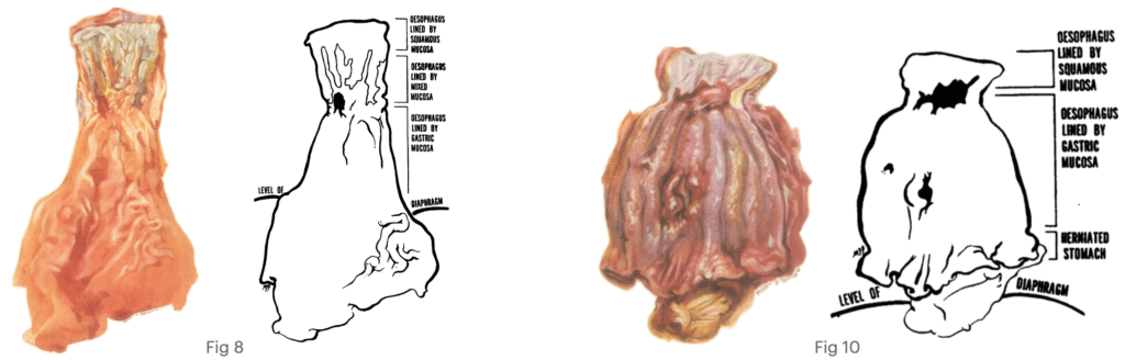 Barrett's Oesophagus Allison Johnstone 1953