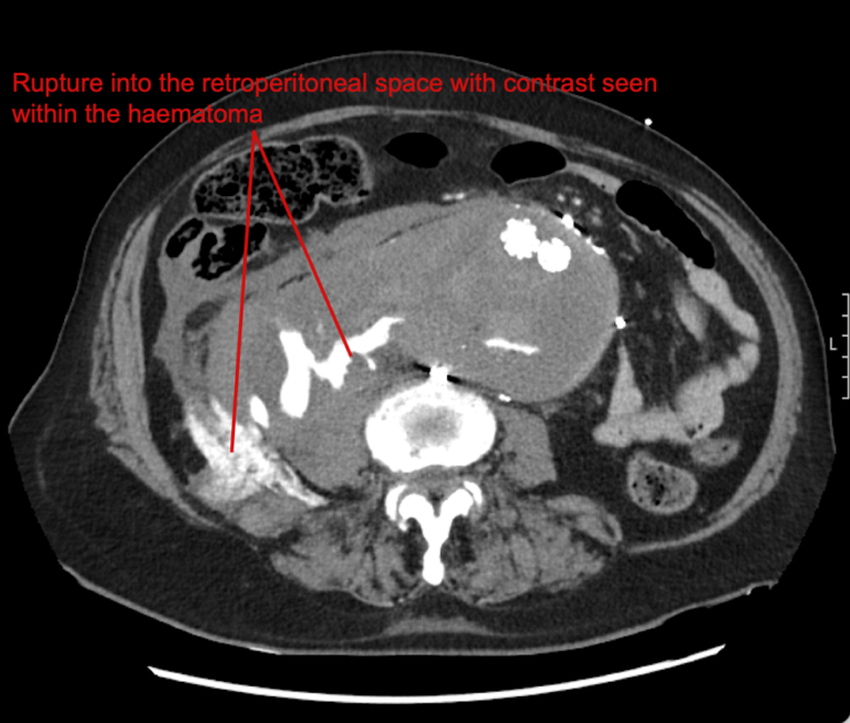CT Case 084 • LITFL • CT scan interpretation