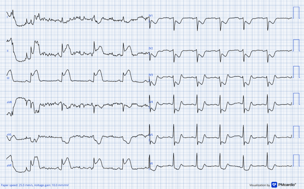 Awake in VF ECG exigency 20 1