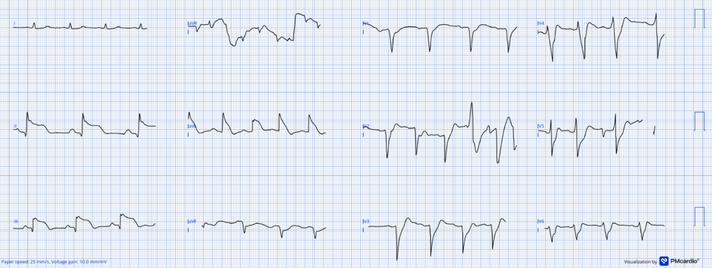 Awake in VF ECG exigency 20 3