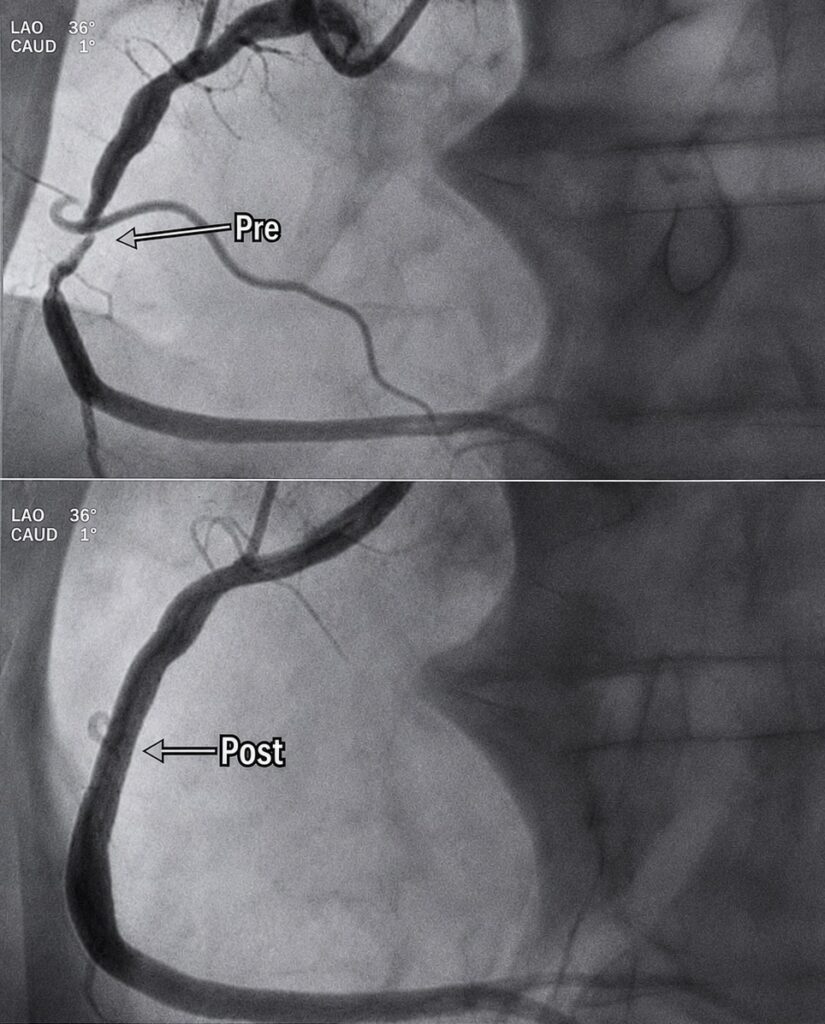 Awake in VF ECG exigency 20 4