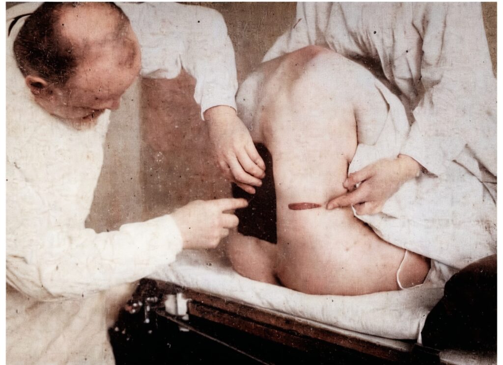 Bier-performing-spinal-anesthetic-1925 enhanced