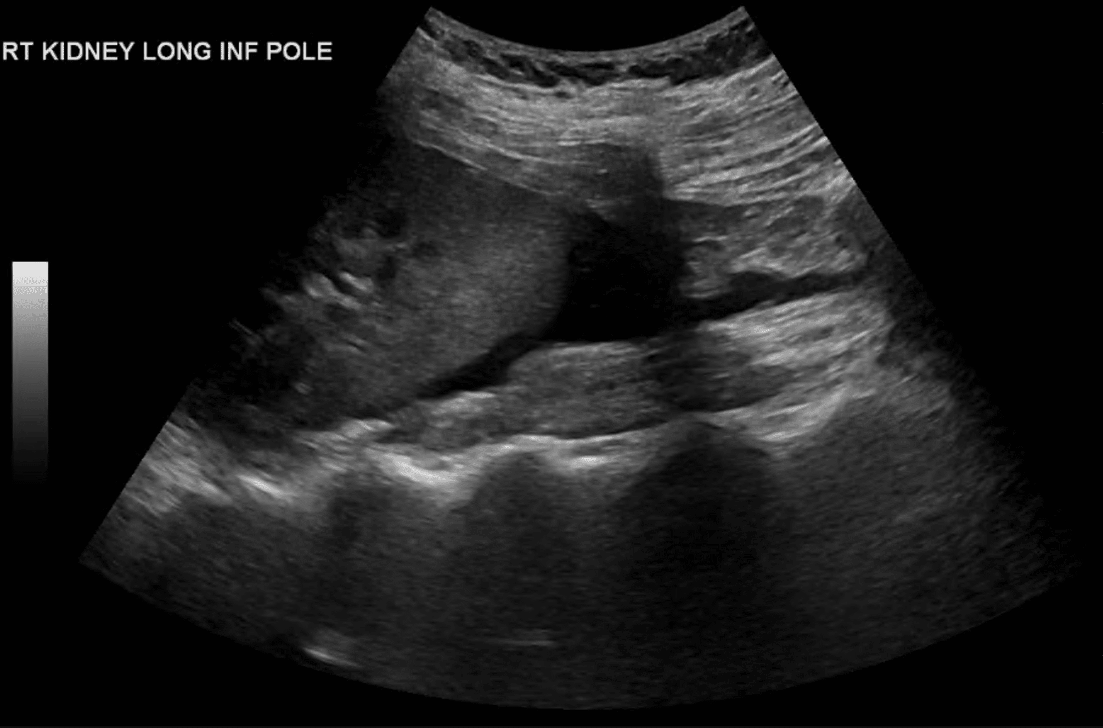 Ultrasound Case 112 LITFL POCUS Top 100