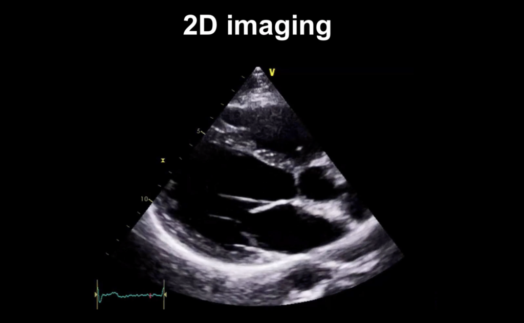 2D echo image that shows the heart's mitral valve