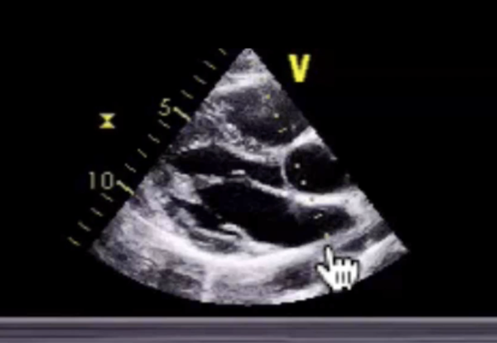 M-mode echo image