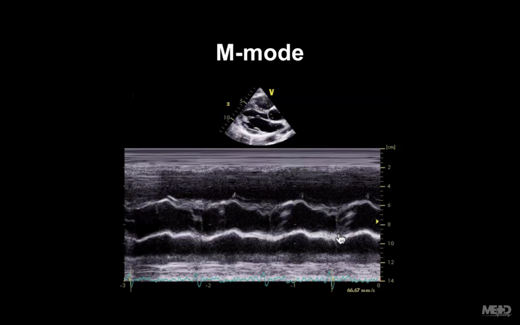 M mode echocardiography image that shows the bicuspid aortic valve and the walls of the aorta.