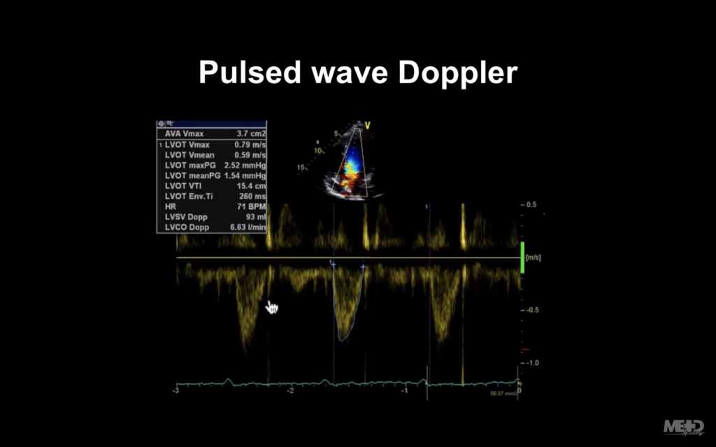 Pulsed wave Doppler image