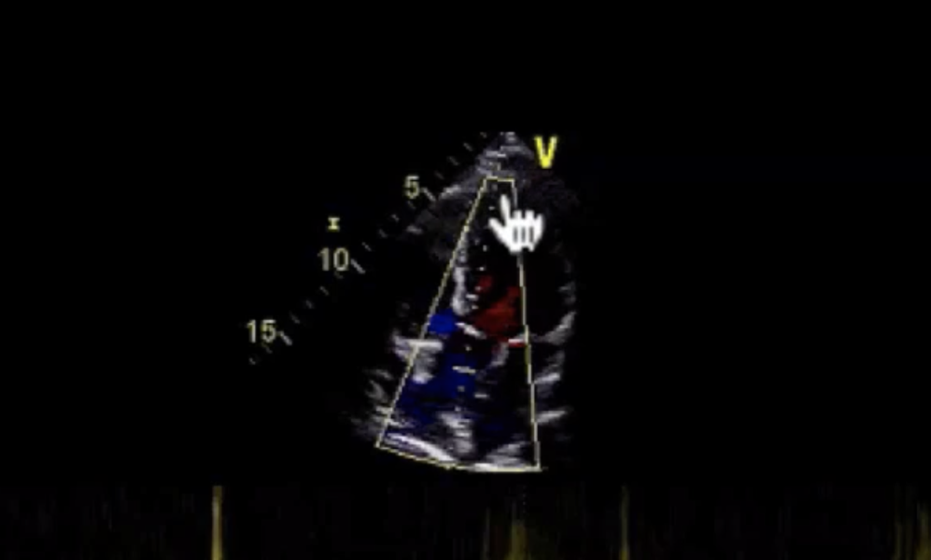 Apex of the ventricle on continuous wave Doppler: the apex of the ventricle is nearest the probe.
