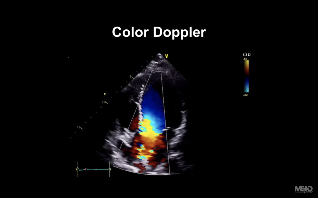 color doppler image (color flow mapping) with a white outline around the color flow sector