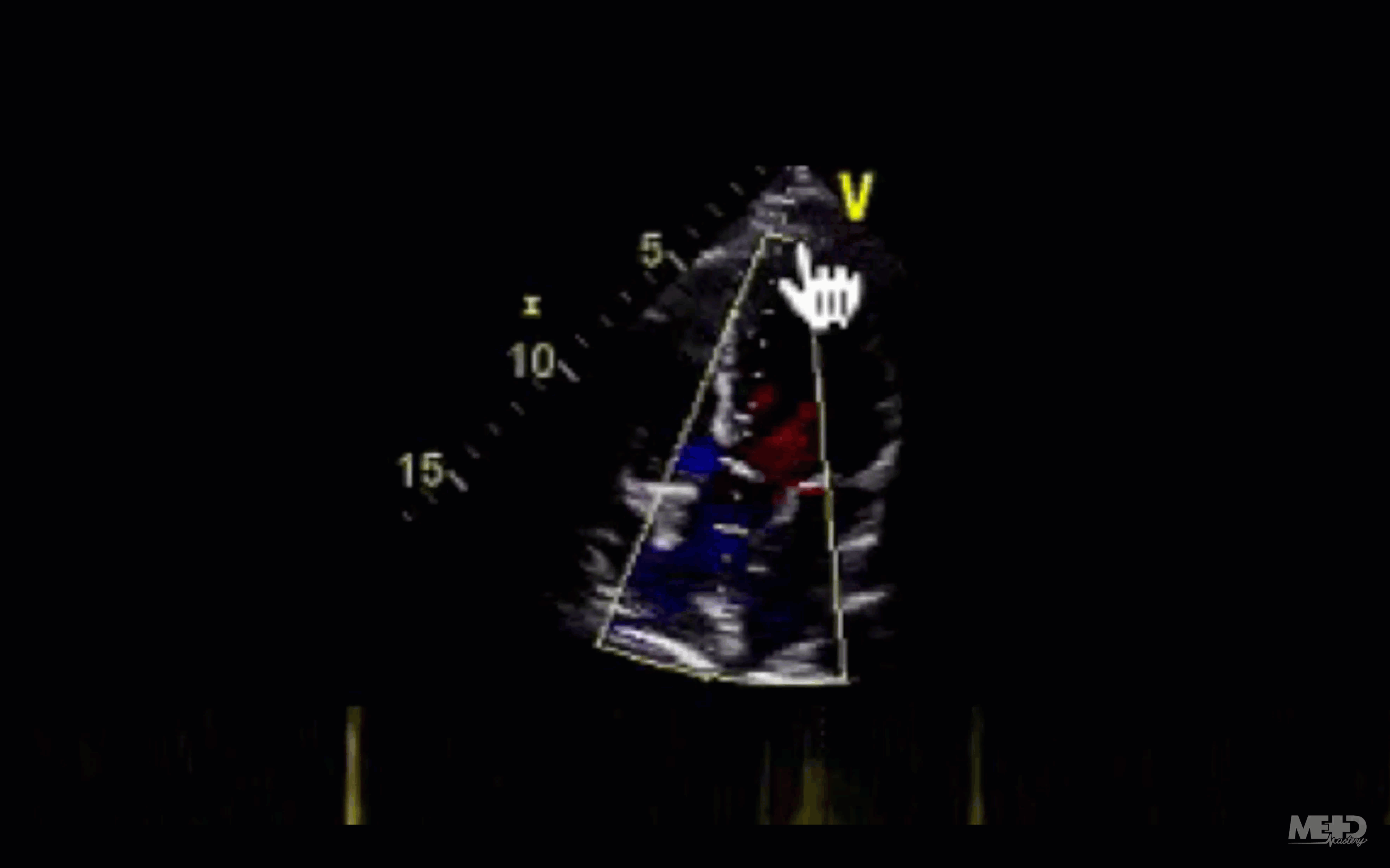 Animated GIF showing a continuous line on the continuous wave Doppler.