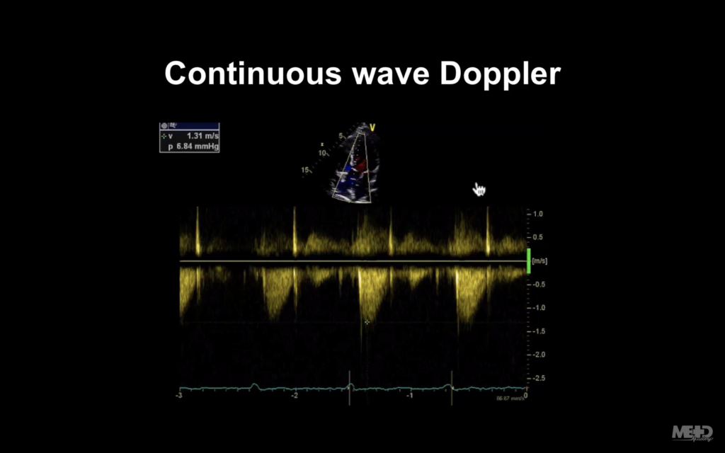 continuous wave Doppler image