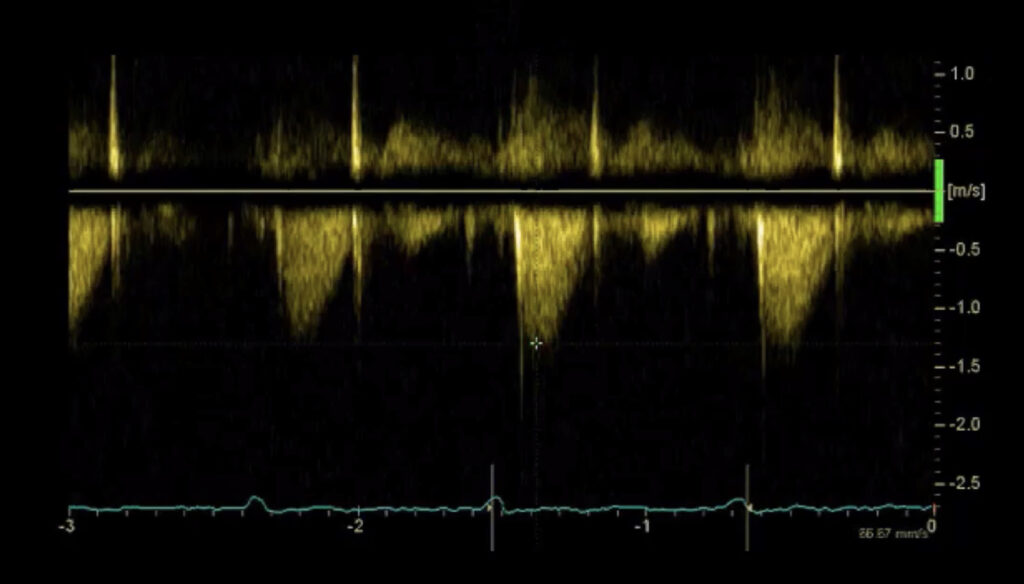 Image of the x-axis and y-axis of a continuous wave Doppler