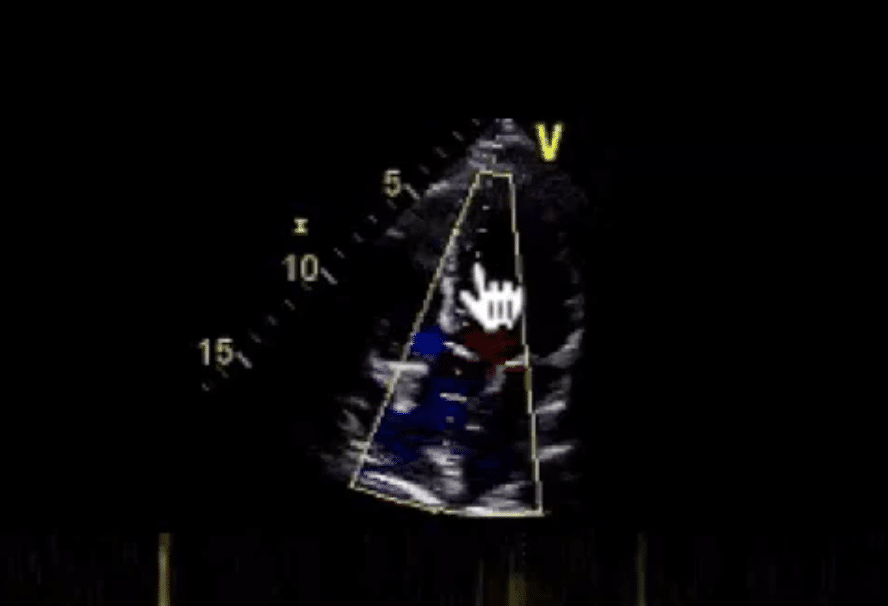 mid cavity - continuous wave Doppler