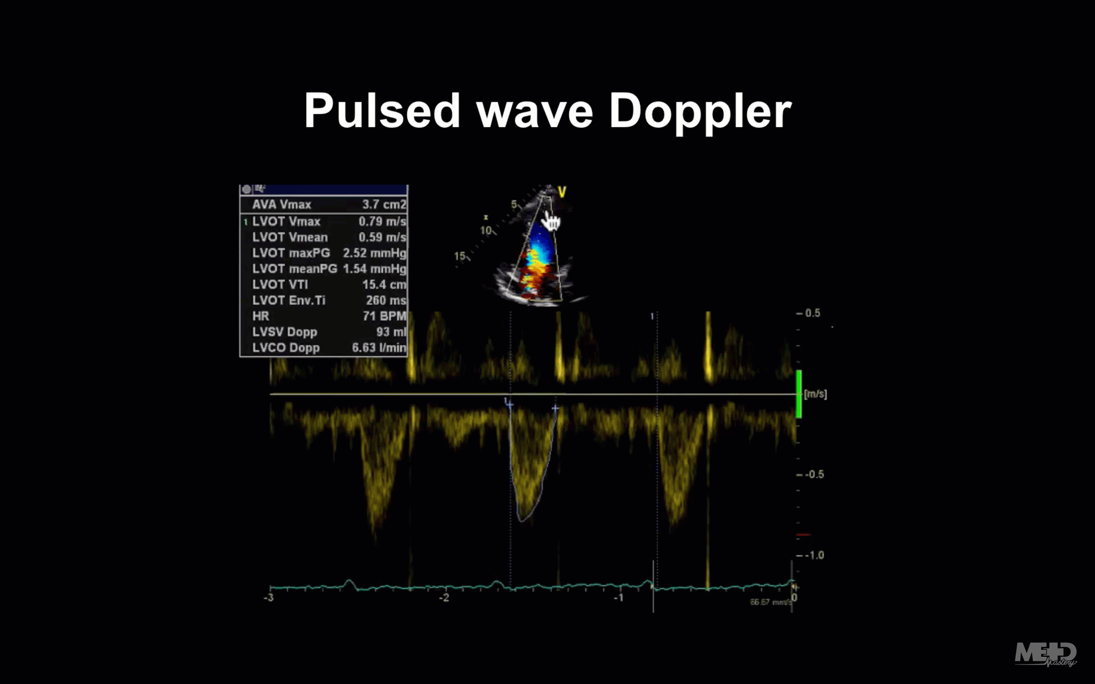 animated GIF of a pulsed-wave Doppler image showing that the flow is parallel to the line.