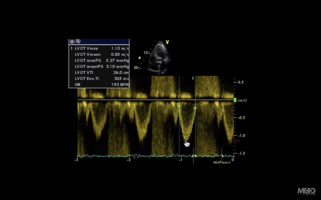 signal on a pulsed-wave Doppler image - the signal is a green line 
