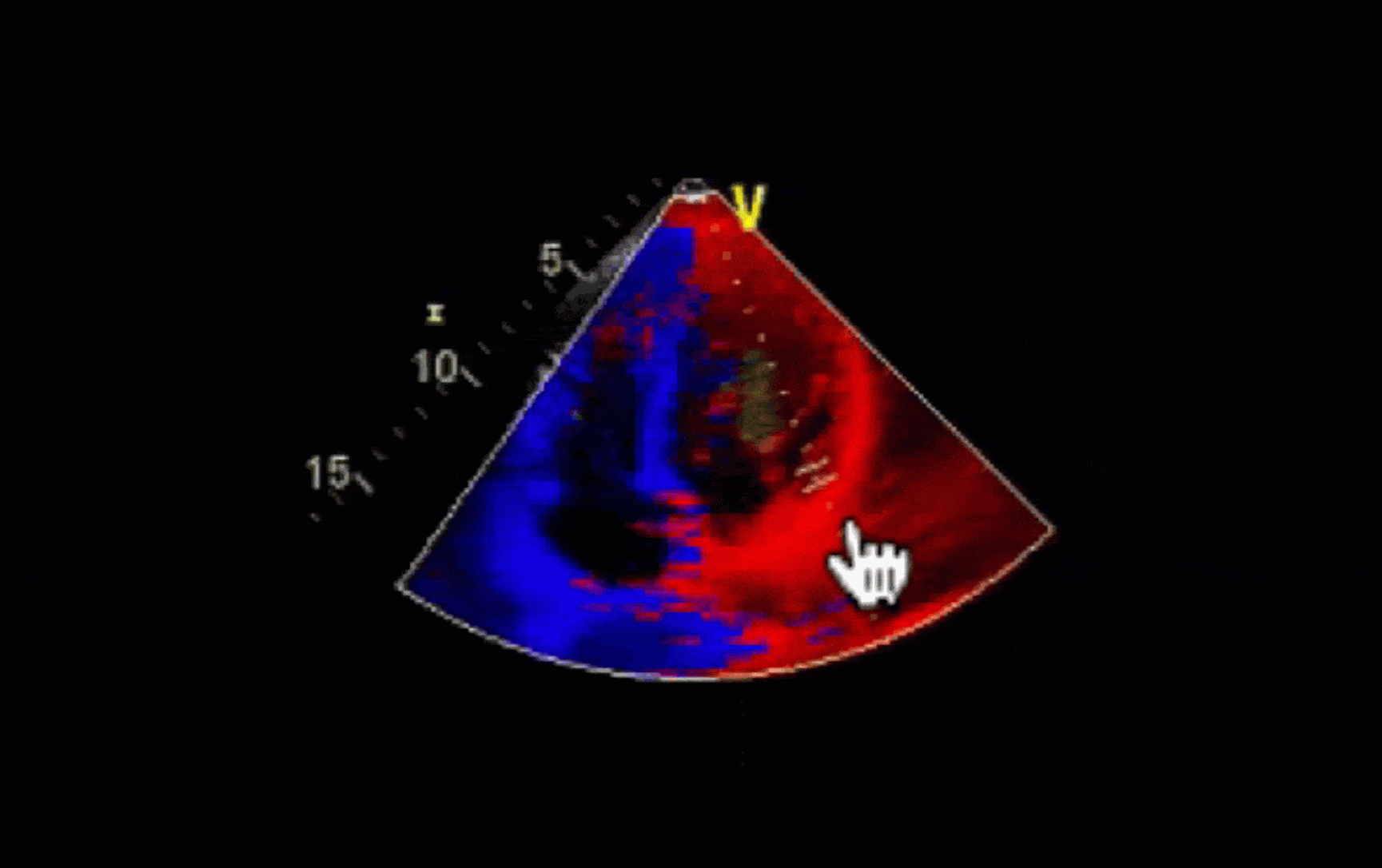 tissue Doppler imaging - walls of the myocardium are visible as a red curve
