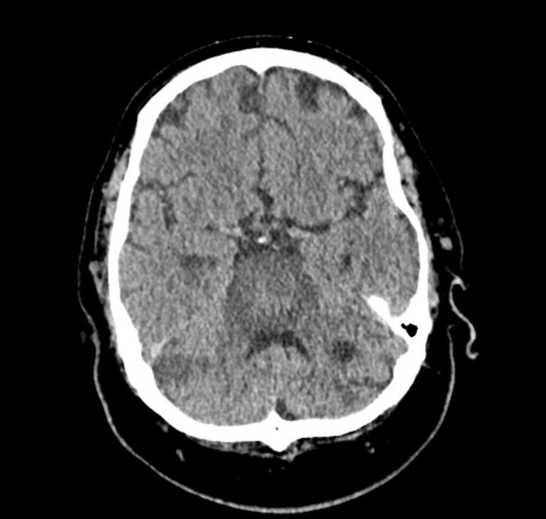 CT Case 083 • LITFL • CT scan interpretation