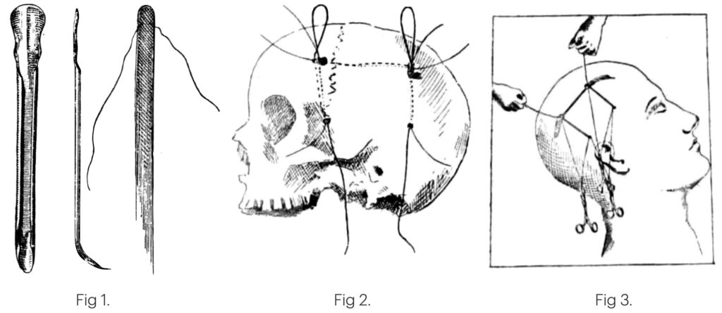 Gigli modified wire saw for neurosurgery 1898