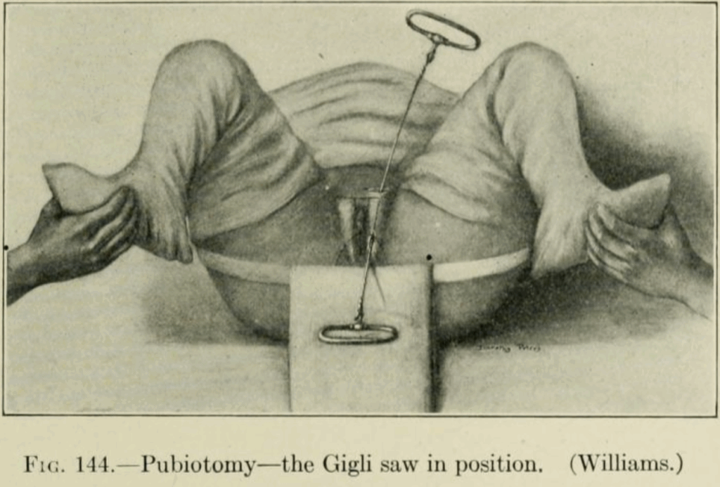 Pubiotomy. Gigli saw position 1922