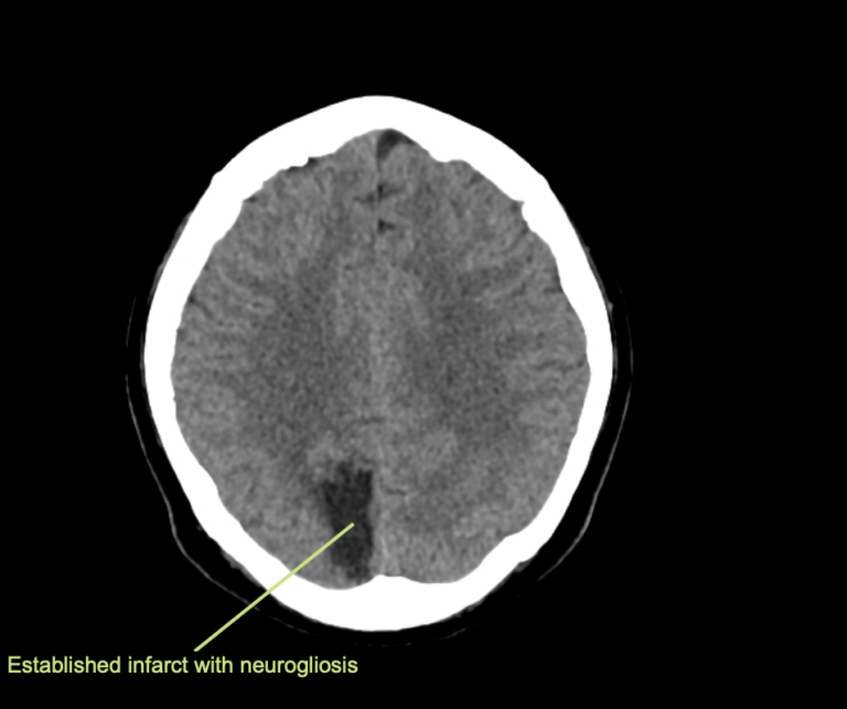 CT Case 091 • LITFL • CT scan interpretation