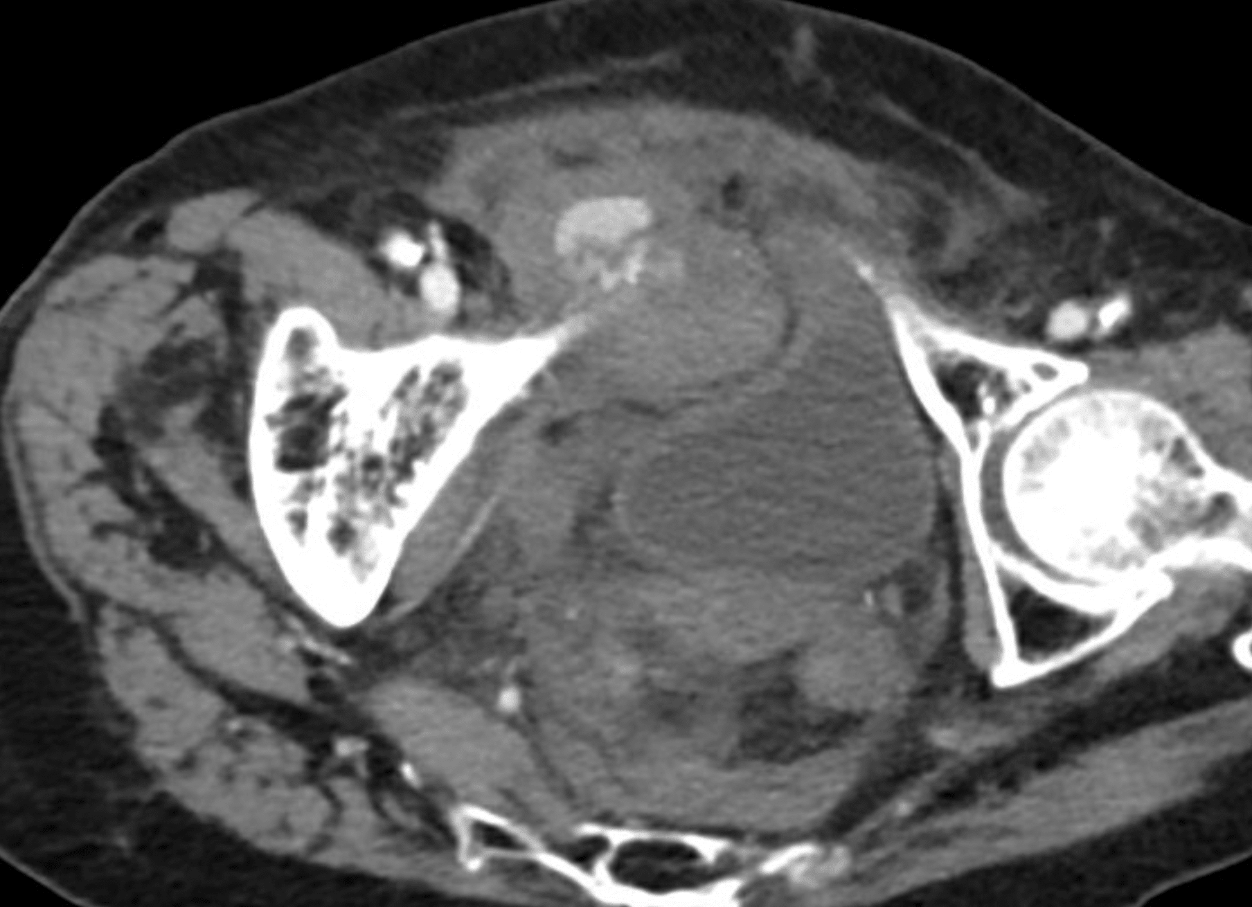 CT Case 097 • LITFL • CT scan interpretation CT Case 097 • LITFL • CT scan interpretation
