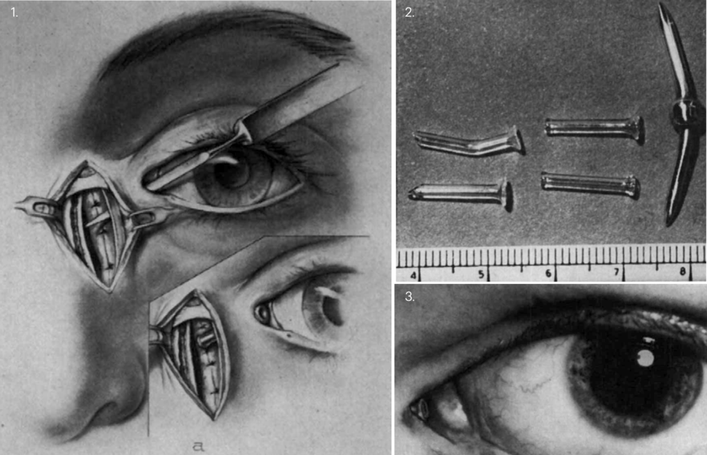 Jones tube and Conjunctivodacryocystorhinostomy