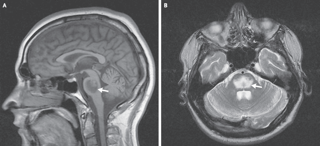 MRI showing CPM