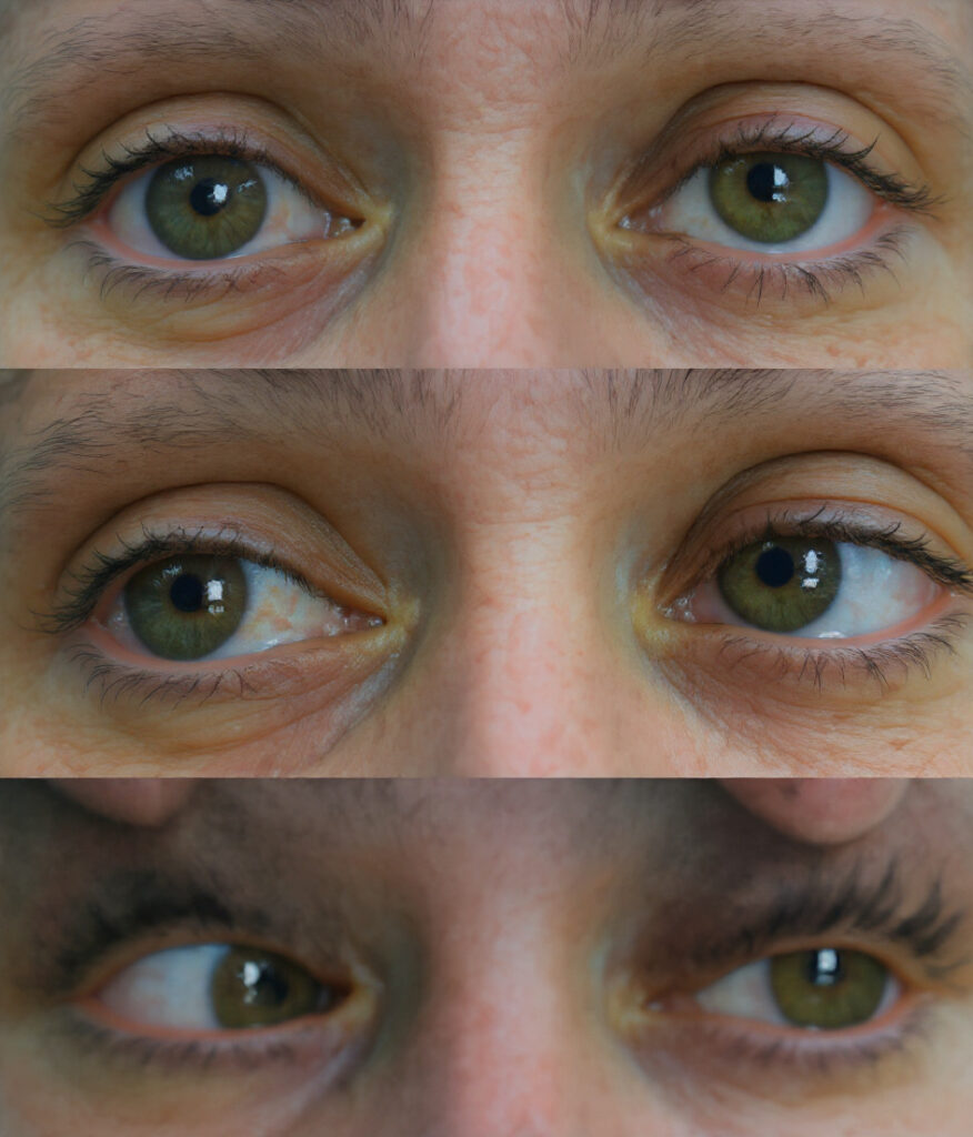left 6th cranial nerve palsy