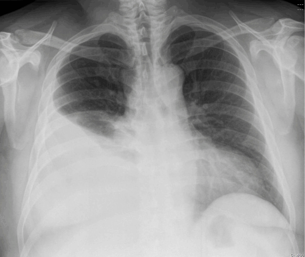 pleural effusion right side CXR